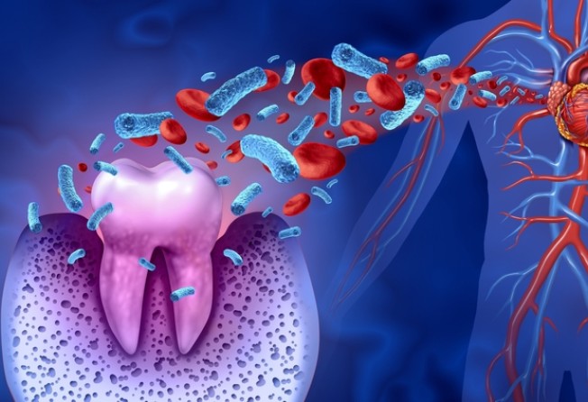 The mouth is home to billions of bacteria, some of which infect gums and bone, but can also cause deposits to accumulate in the arteries around the heart. Illustration: Shutterstock