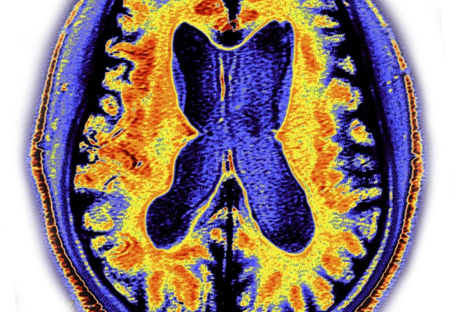 A brain scan showing signs of dementia. Photo: Getty Images