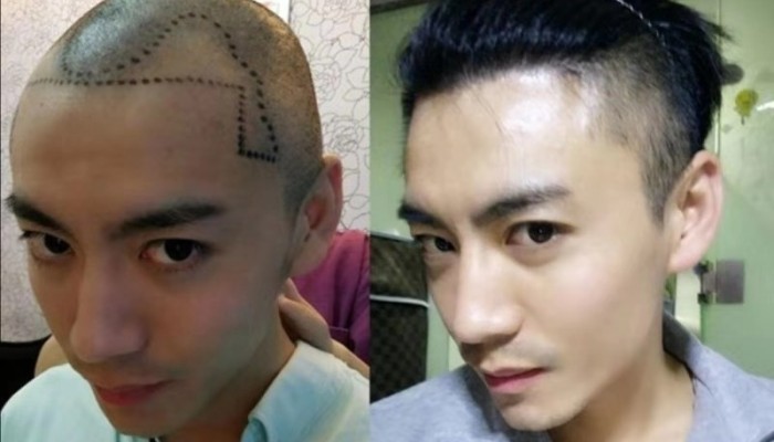 Millennial Chinese Men Going Bald Younger Getting Hair Transplants To Restore Their Locks And Confidence South China Morning Post