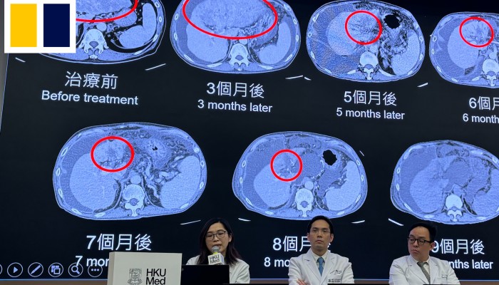 stage 4 liver cancer treatment options