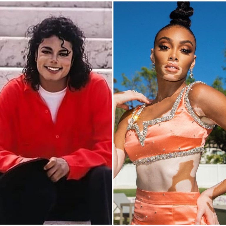 5 celebs with vitiligo from Michael Jackson and Winnie Harlow to