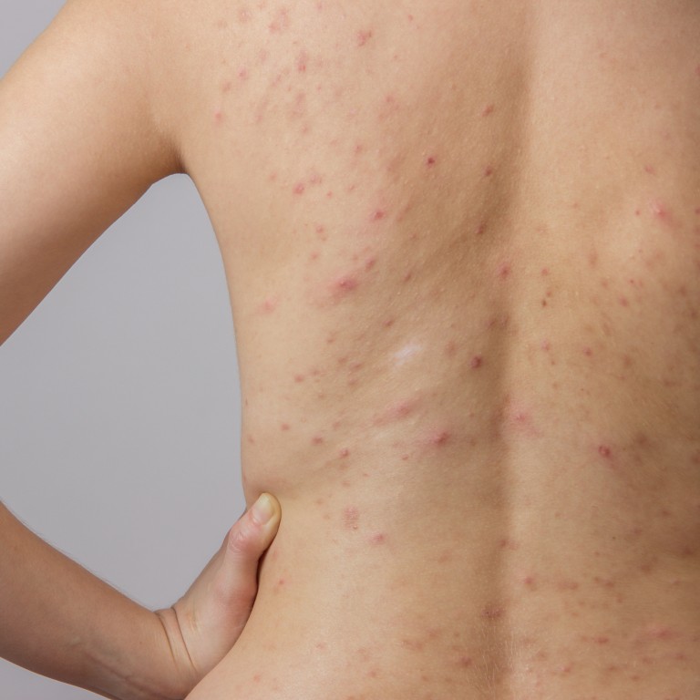 How to Get Rid of Chest Acne: Treatments and Best Practices