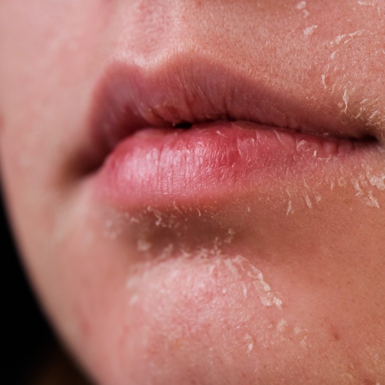 What causes dry skin, how to treat it, products to try and is it