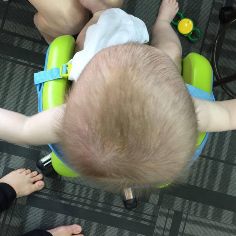 Flat head syndrome – facts about the condition behind the helmet-wearing  baby fad and how to prevent or fix it