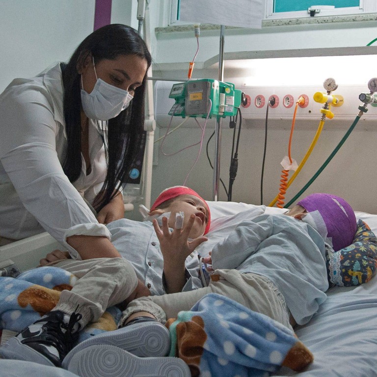 Conjoined twins separated in 27hour surgery with help of virtual