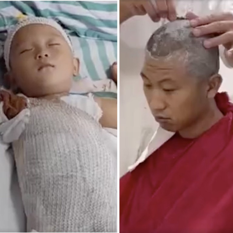 ‘I will give him anything’ parents shave heads to donate scalp tissue