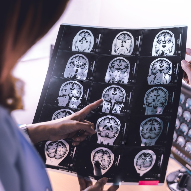 Why should you have a brain scan to test for dementia when there’s no