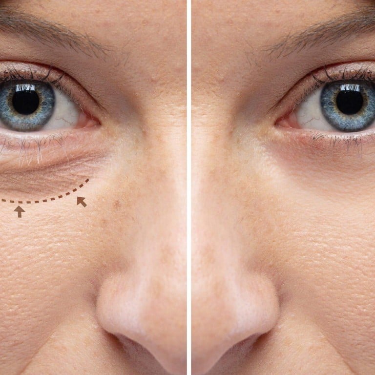 Blepharoplasty is a popular cosmetic surgery that revitalises the area under the eyes. Photos: Handout
