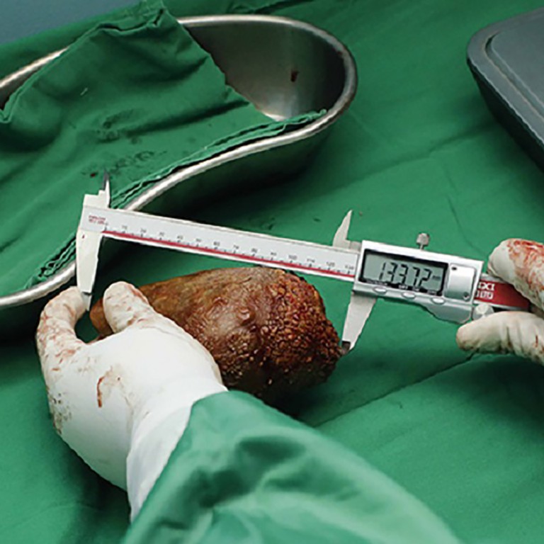 Sri Lanka doctors remove ‘world’s largest kidney stone’ – longer and