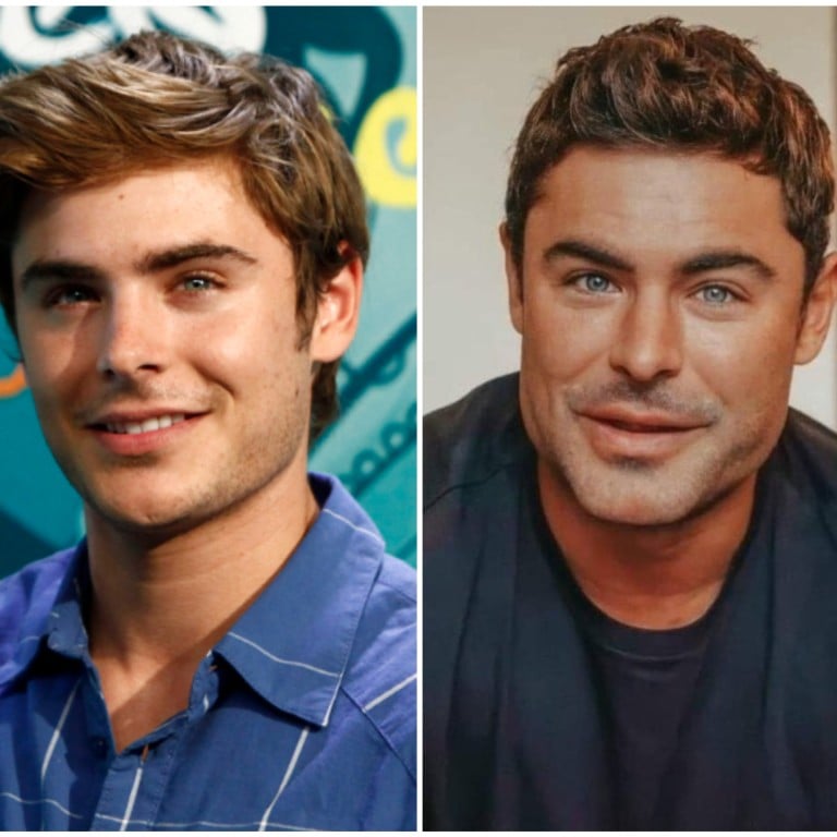 Zac Efron went viral for his noticeably larger jaw last year – and now the rumours are back. Photos: AP, @pazzeskamilan0/X