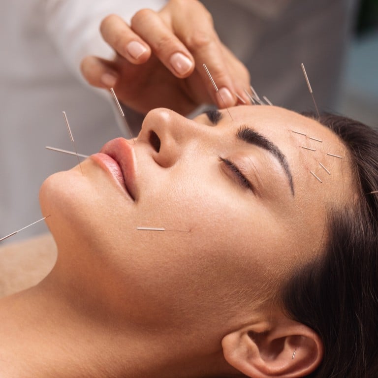 Cosmetic acupuncture is gaining popularity as people turn to a gentler and more holistic approach towards anti-ageing. Photo: Getty Images