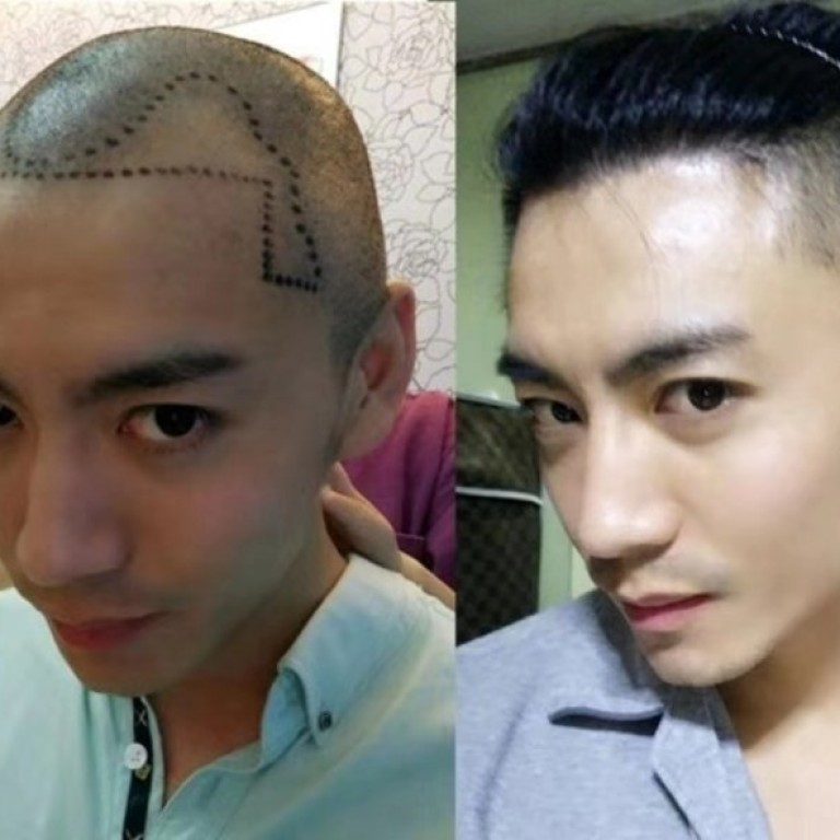 Millennial Chinese Men Going Bald Younger Getting Hair