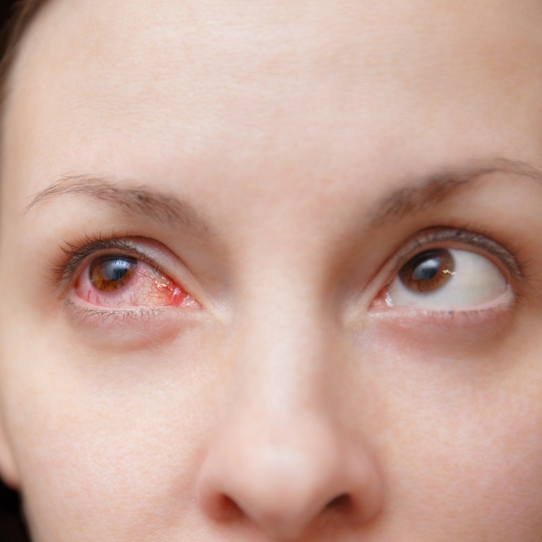 How To Tell If Your Bloodshot Eye Is Conjunctivitis Or Something A