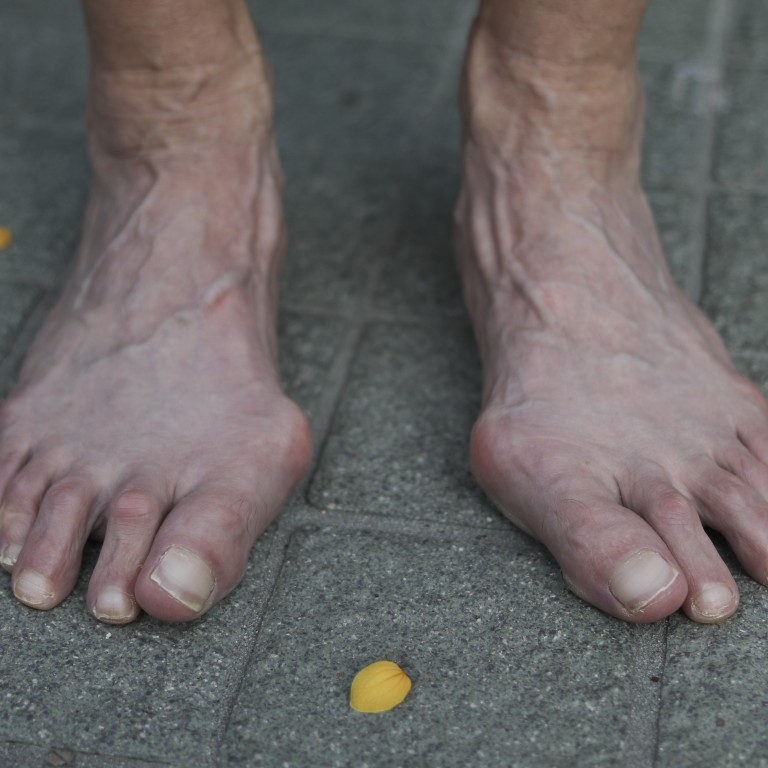 bunions on heels of feet