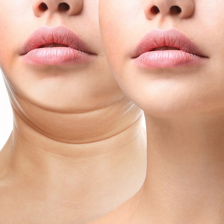 Why Plastic Surgery Is On The Rise During Pandemic Everybody Is Fat And No One Wants To Be South China Morning Post