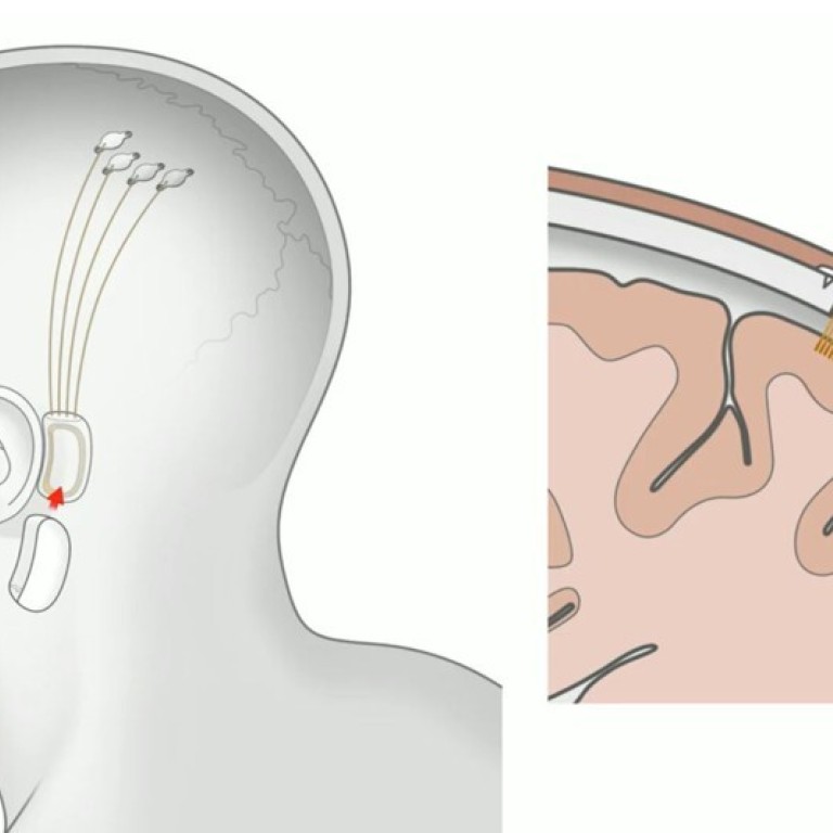 Elon Musk S Neuralink Begins Brain Chip Tests On Pigs With Aim To Cure Human Diseases One Day South China Morning Post