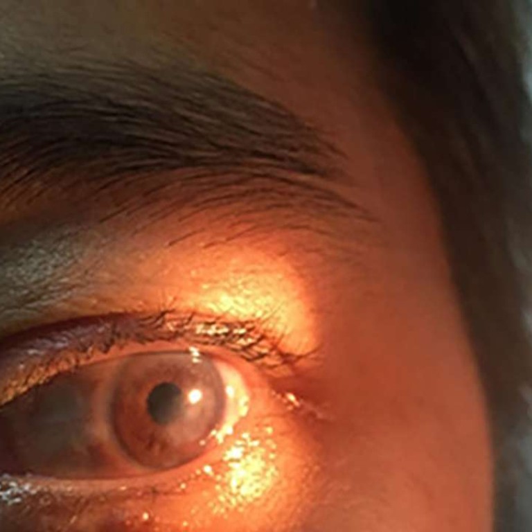 Chinese woman expected to regain eyesight after transplant using pig’s