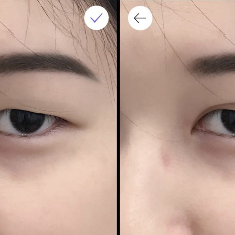 Double eyelid surgery hong on sale kong