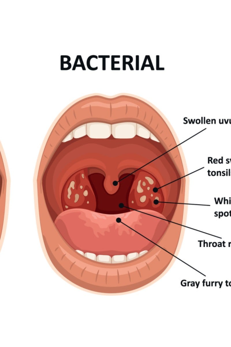 red spots on tonsils