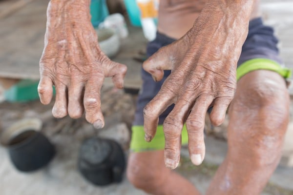 Leprosy, if untreated, can damage nerves, meaning a sufferer is less likely to react to pain, from burns, say, or pressure - which can destroy tissue. We look at the disease’s symptoms, treatment, transmission and stigma, and whether it’s contagious or curable. Photo: Shutterstock Leprosy, if untreated, can damage nerves, meaning a sufferer is less likely to react to pain, from burns, say, or pressure - which can destroy tissue. We look at the disease’s symptoms, treatment, transmission and stigma, and whether it’s contagious or curable. Photo: Shutterstock