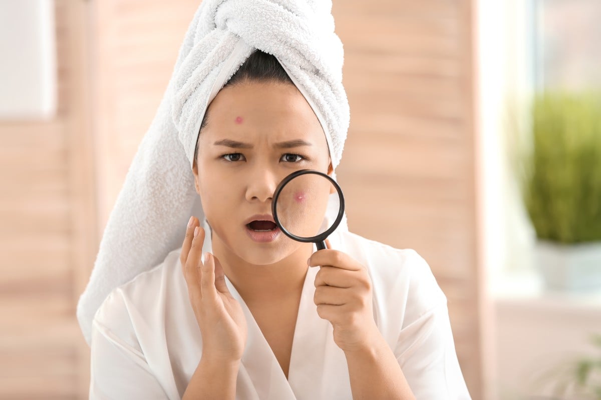Most people need to deal with acne at some point in their lives - here's how to handle it.