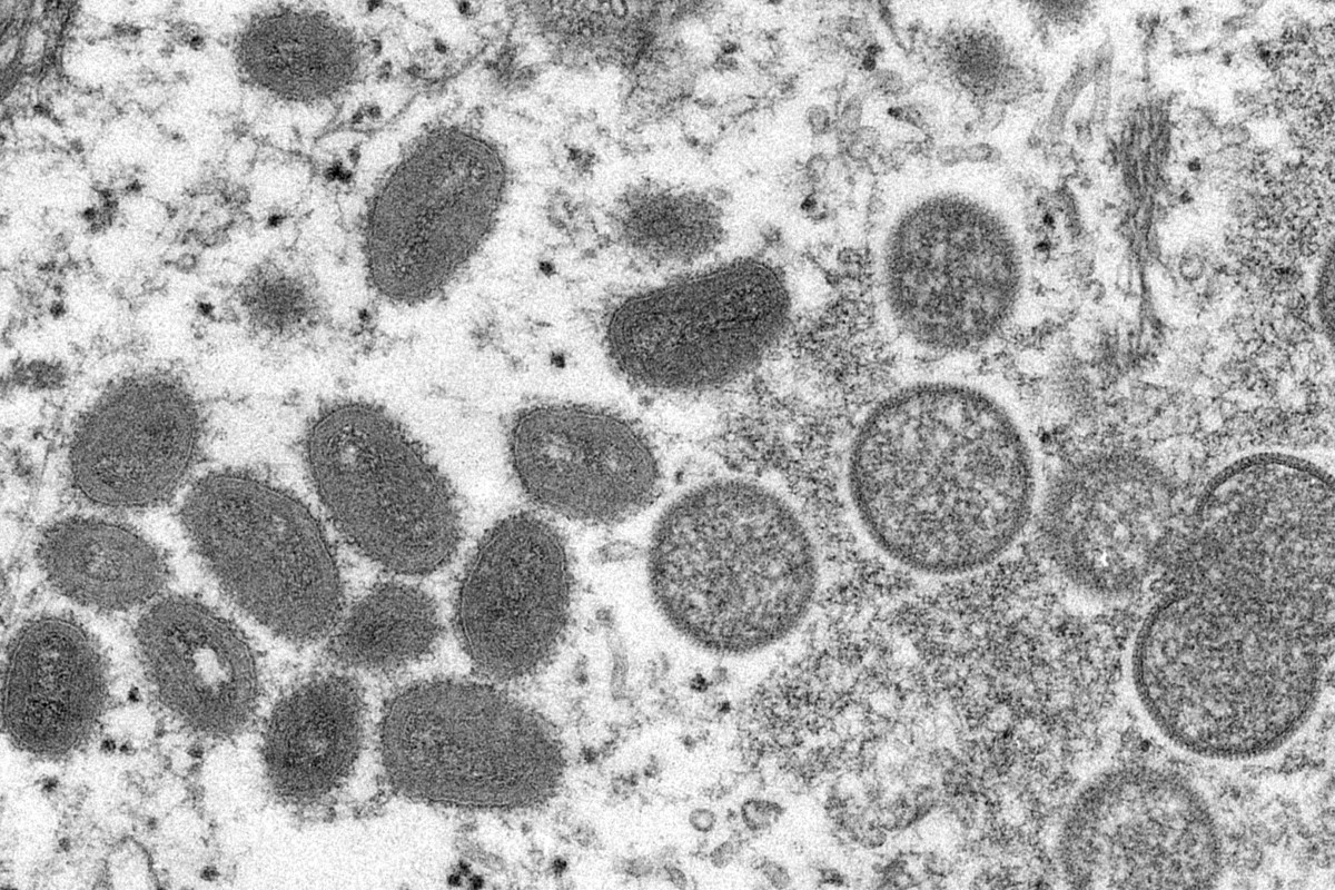 Monkeypox is a disease caused by a virus in the orthopoxvirus group, which includes smallpox. Photo: TNS