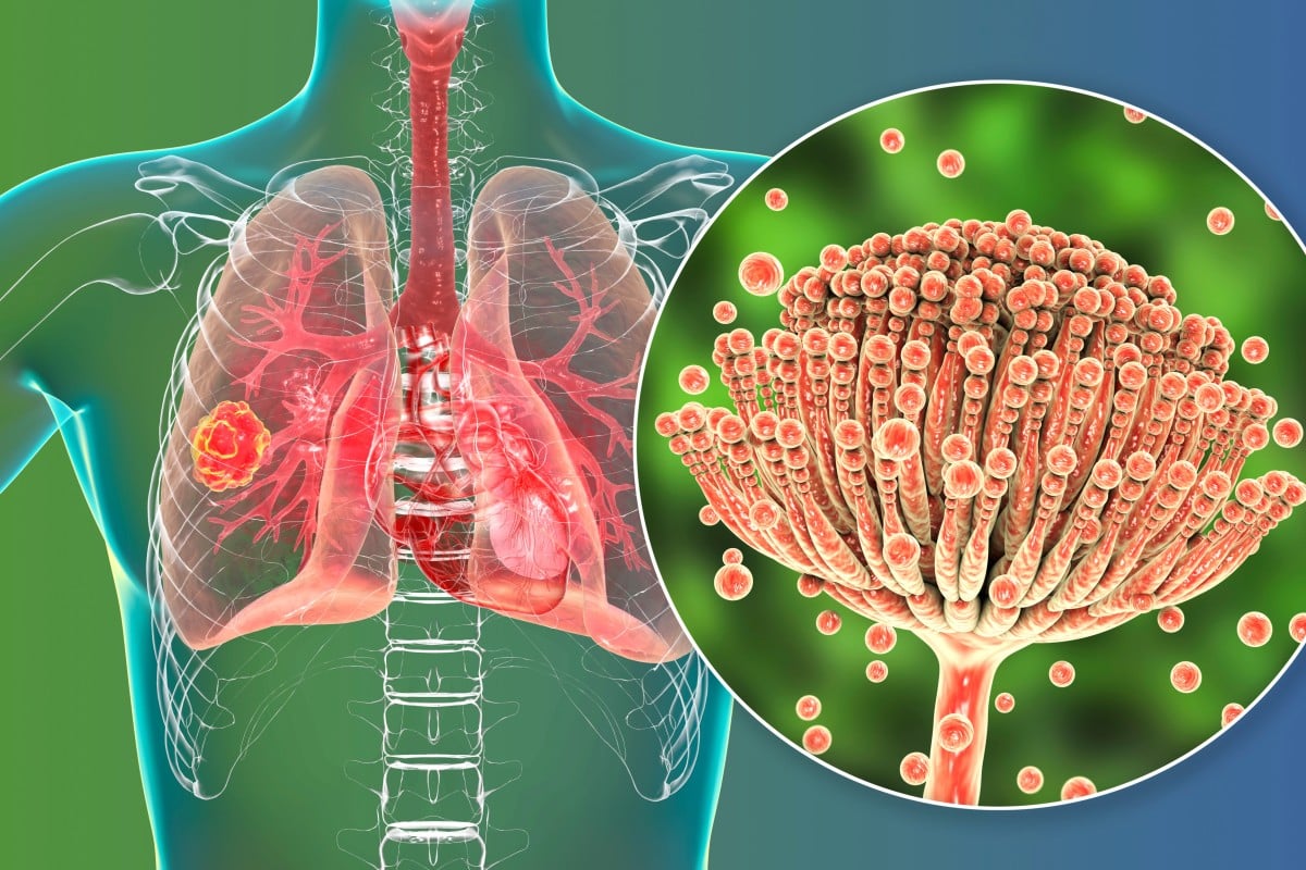 Antifungal resistance, linked to overuse in agriculture and medicine, poses growing global health risks. Photo: Shutterstock 