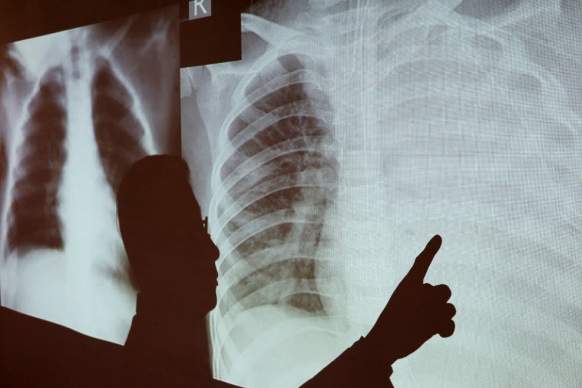Pneumonia is an infection of the lungs.
