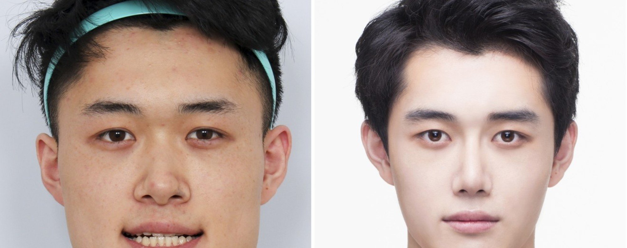 Lee jong top suk plastic surgery