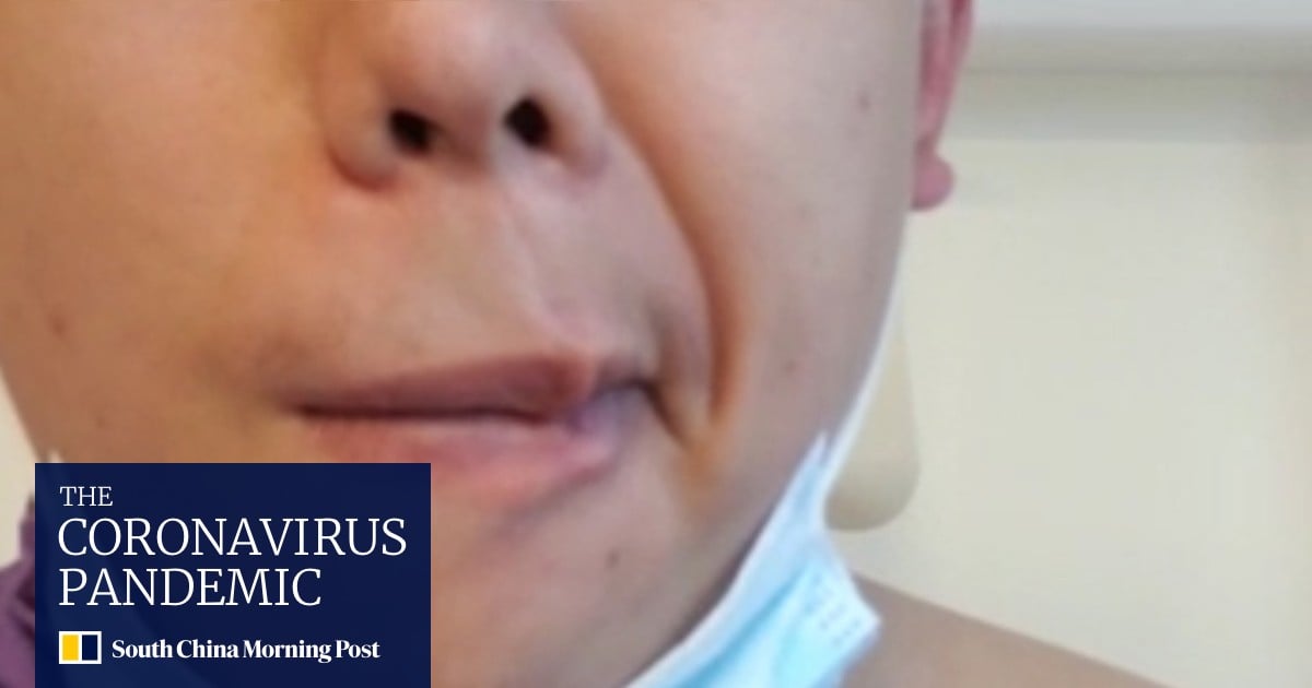 Hong Kong man describes facial paralysis ordeal after Covid-19 vaccine... image