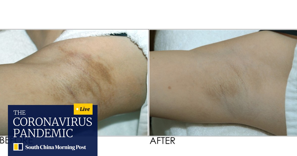 Skincare For Your Armpits Why Underarm Whitening Is A Beauty Treatment In Southeast Asia South China Morning Post