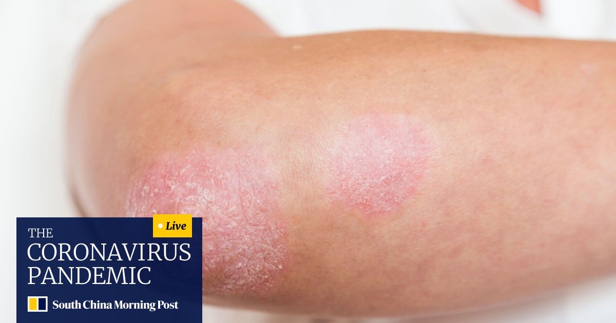 Early Stage Pancreatic Cancer Skin Rash Pictures / Pancreatic Cancer ...