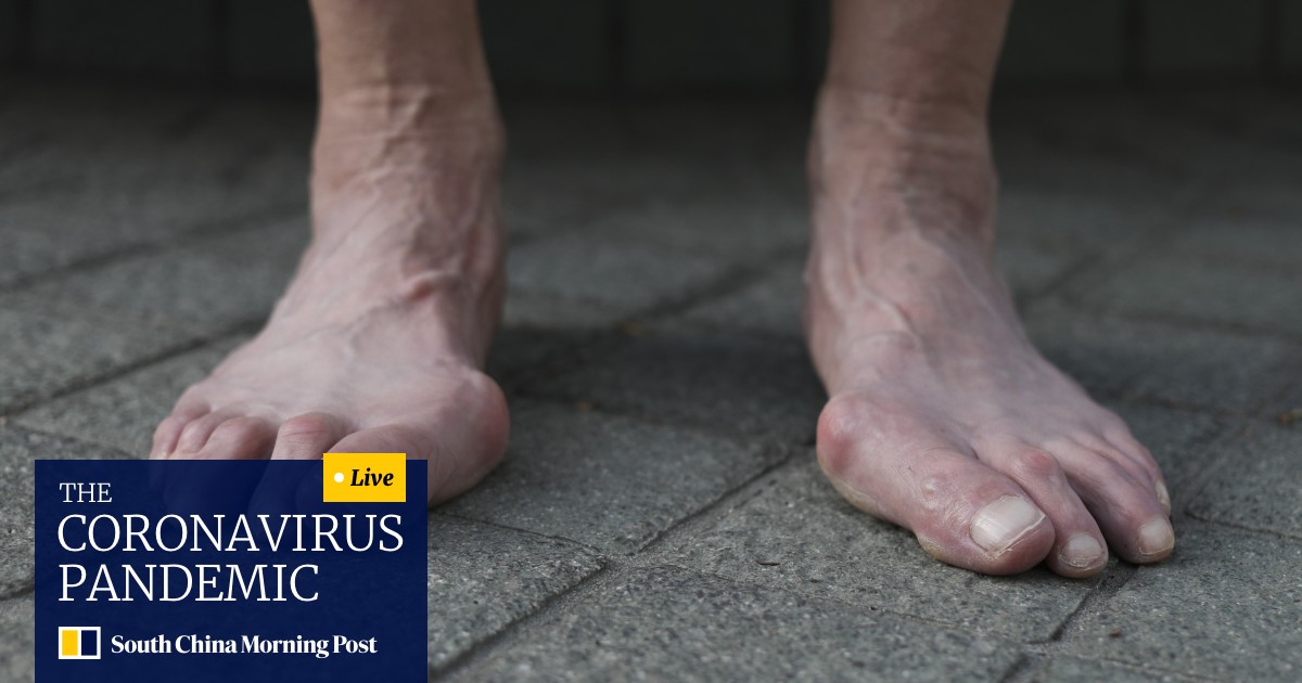 Why Do Your Toes Hurt The Causes Of Bunions And What Can Be Done To Treat Your Feet South China Morning Post