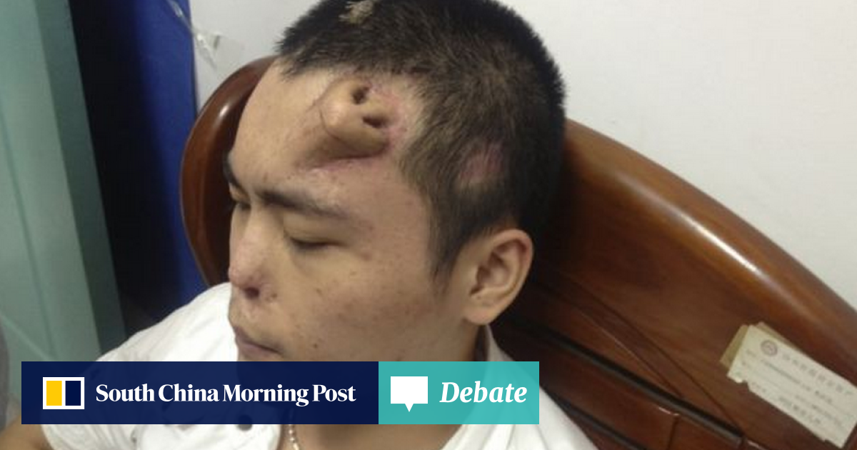 Chinese doctor builds new nose on man's forehead | South China
