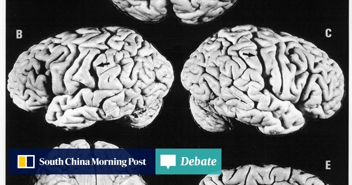 Albert Einstein Brain Vs Normal Brain