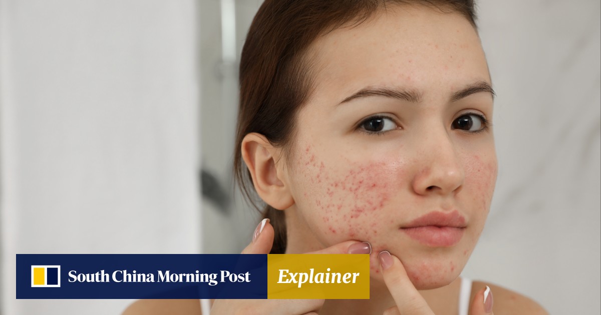 Acne treatment myths busted, from breakouts caused by greasy foods and