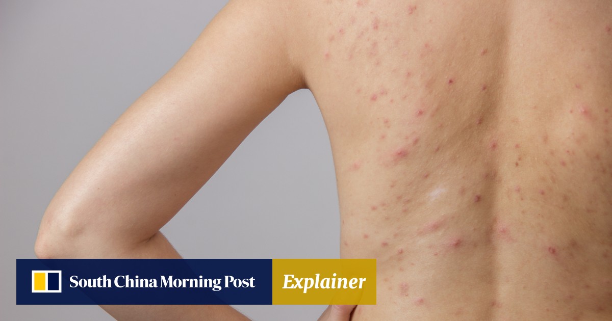 Explainer Body acne what causes it including hot humid weather and five of the best products to treat it South China Morning Post