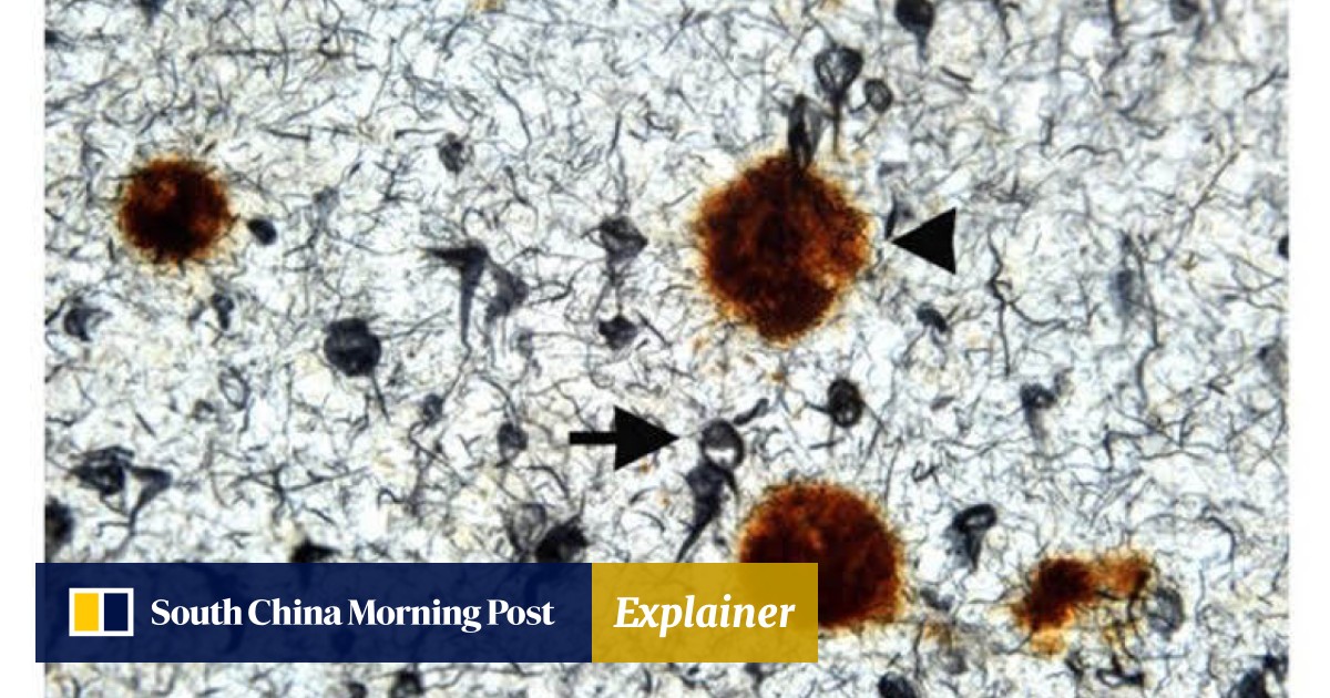 Unravelling two Alzheimer’s markers what are amyloid plaques and tau