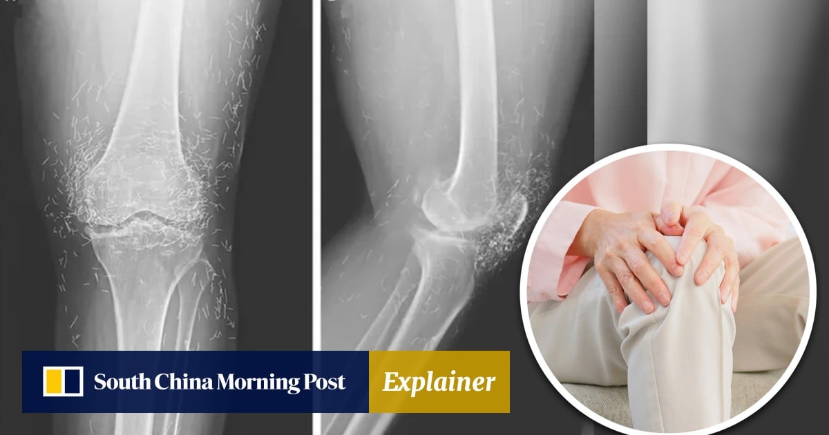 Explainer | Gold thread acupuncture uses gold wires for pain relief, could cause infections, tissue damage