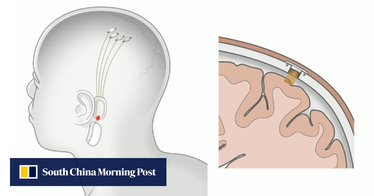 Elon musk’s neuralink is exciting and terrifying to people in china