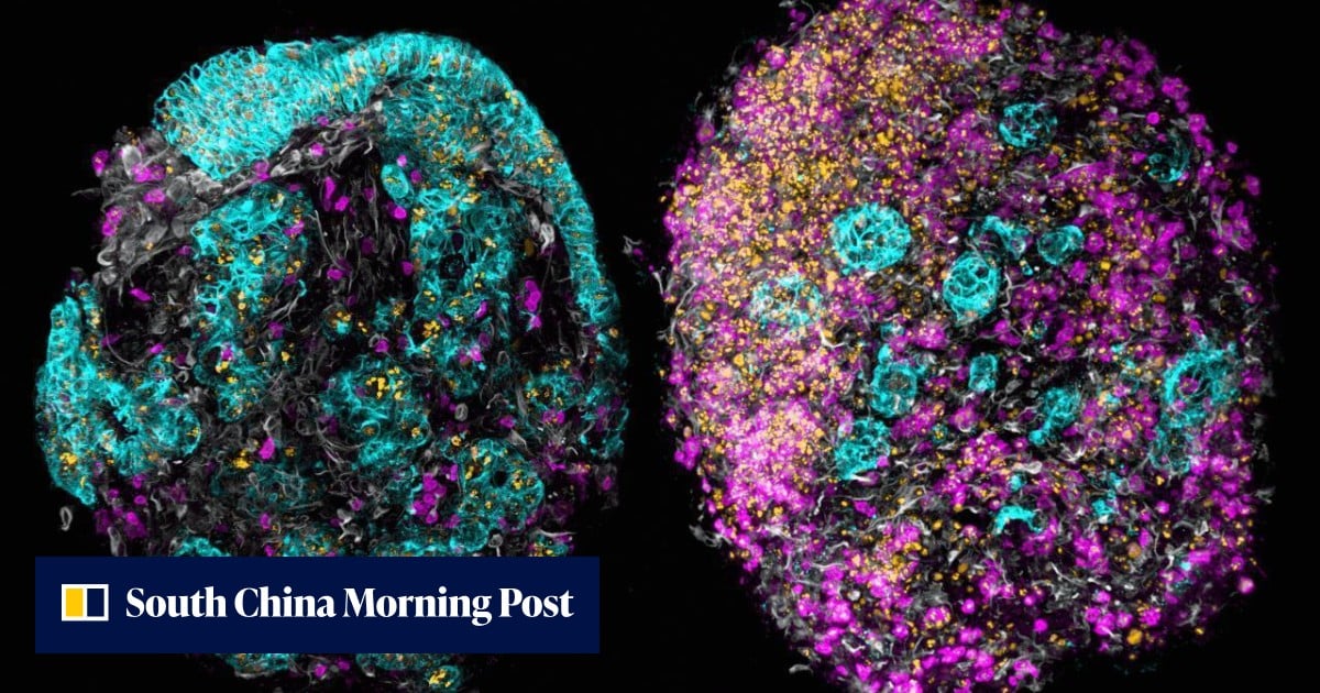 Clues in the Blood: Solving the Mystery of Cancer of Unknown Origin
