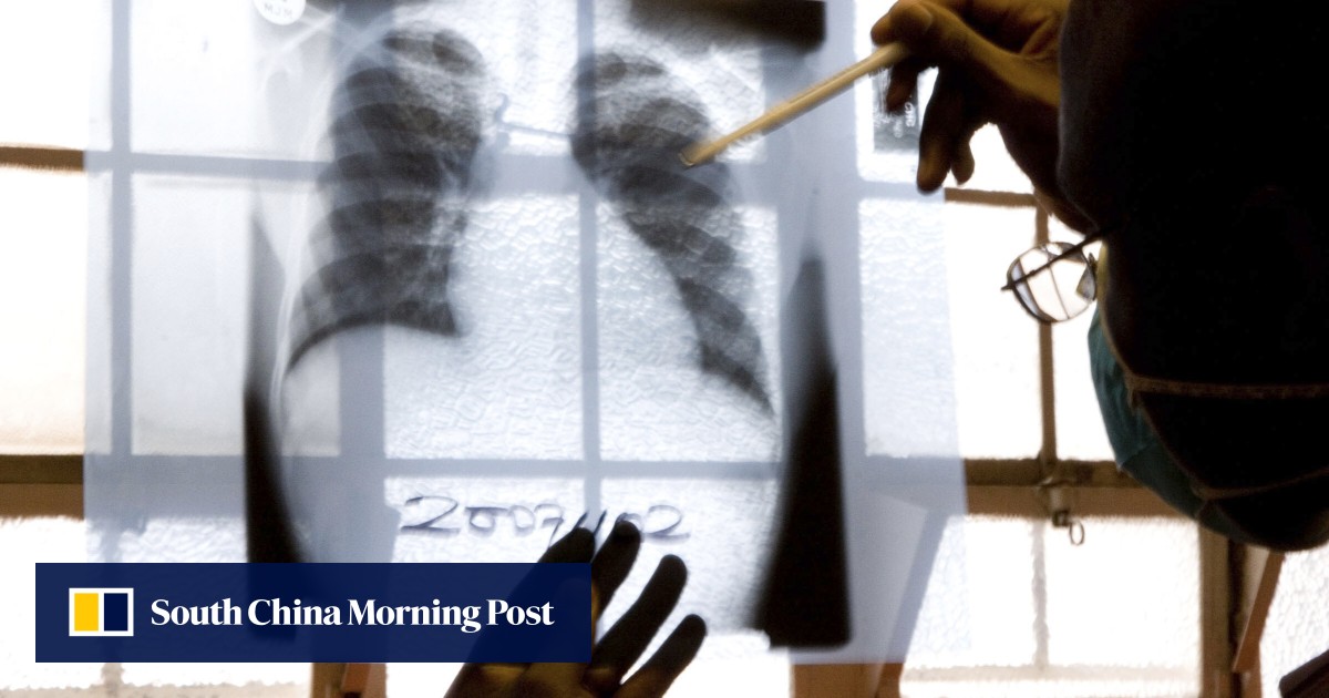Tuberculosis on the rise in Southeast Asia due to Covid-19 disruptions