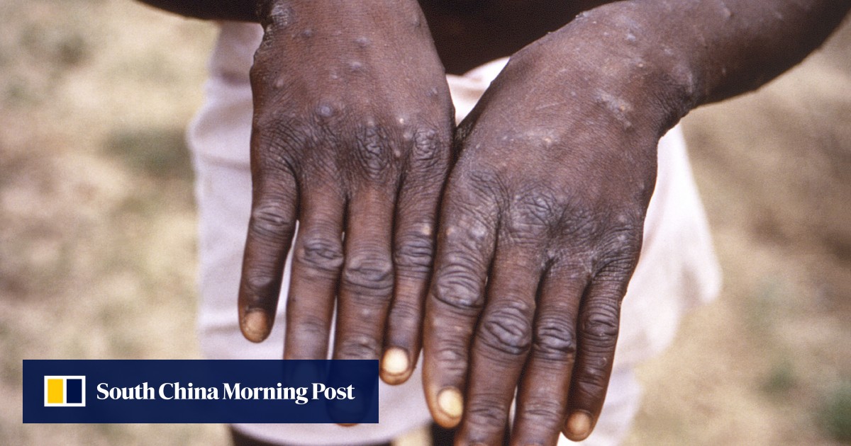 Singapore and South Korea report first monkeypox cases South China