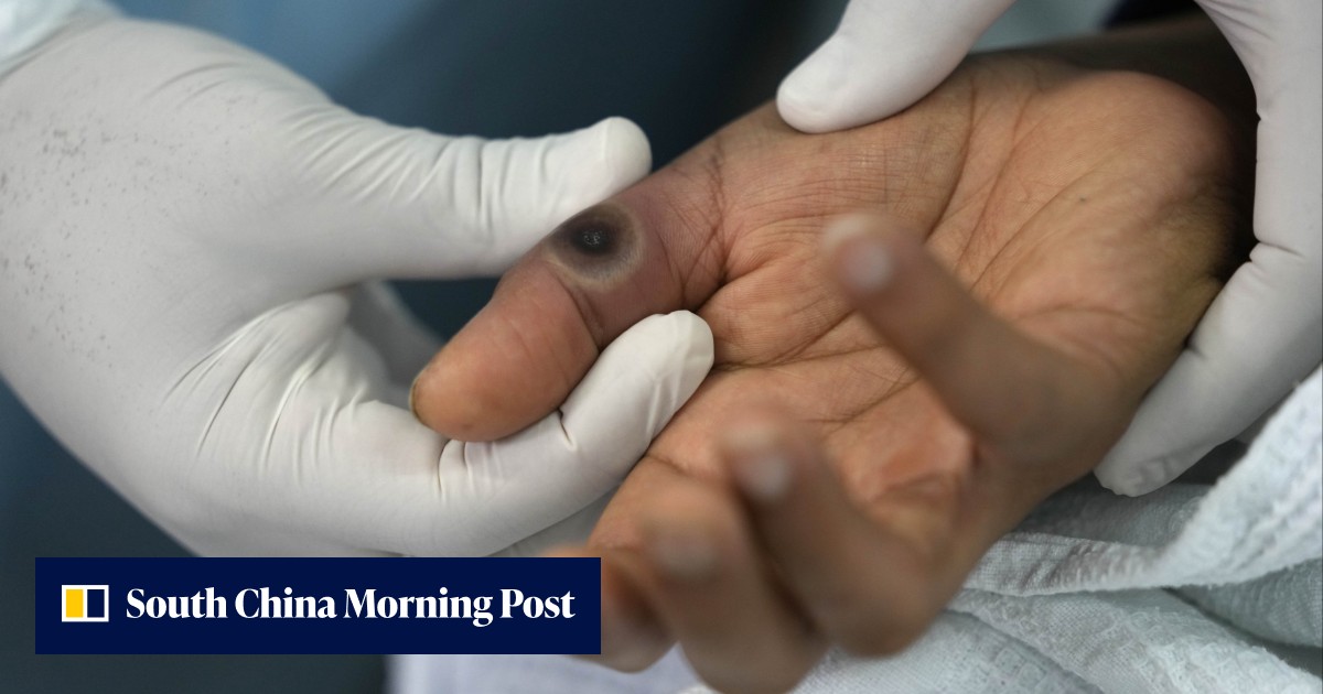 China records first monkeypox case | South China Morning Post