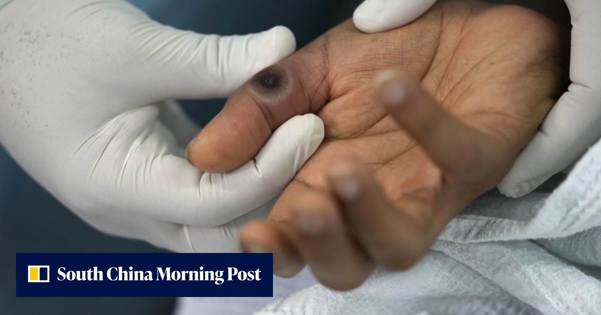 Smallpox Hand Image Are smallpox vaccines effective against the new monkeypox variant? Hong ...
