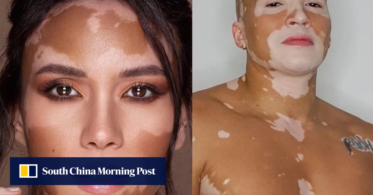 A cure for vitiligo? New US$2,000 treatment is restoring