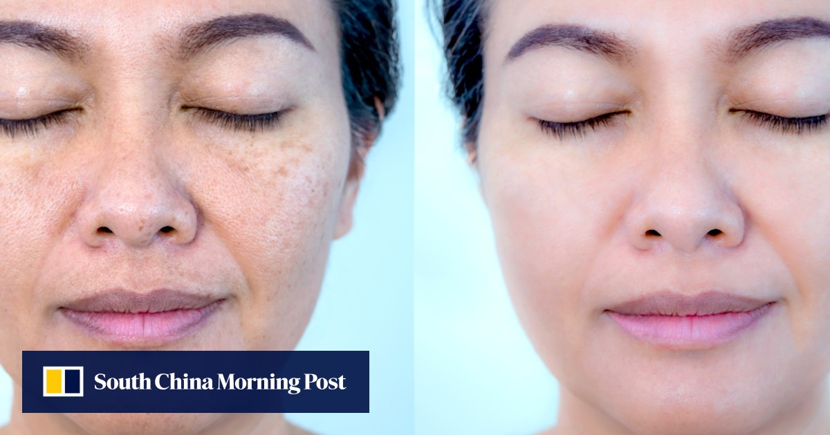 How ‘whitening’ creams can damage your skin, and what to use instead