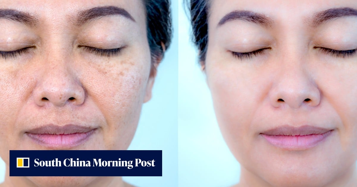 Skin Bleaching Risks Skin ‘whitening’ risks: why you shouldn’t use lightening creams and ...