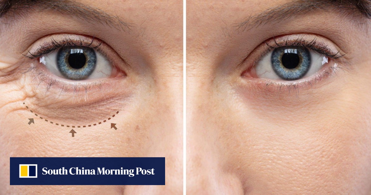 Eyelid Surgery