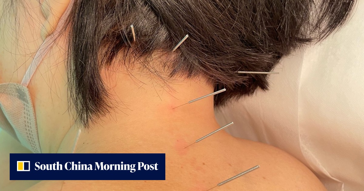 How migraines can be treated with traditional Chinese medicine – 20 ...